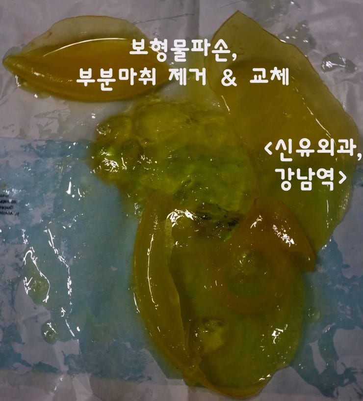 보형물파손이 검진상 발견되어 부분마취로 교체수술(스무스로) 받으신 분 