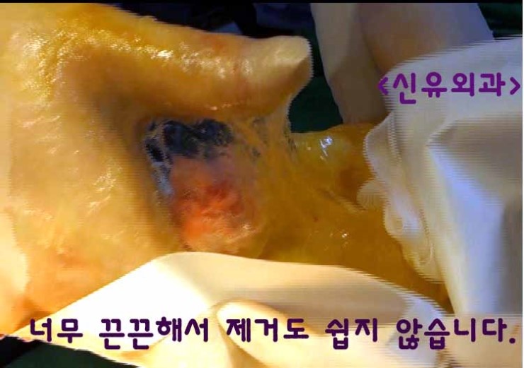 SBS기사, "터진 가슴 보형물, 모유에 섞여 아기 입속으로" : (--> 유방검진을 꼭 하셔야 합니다. )