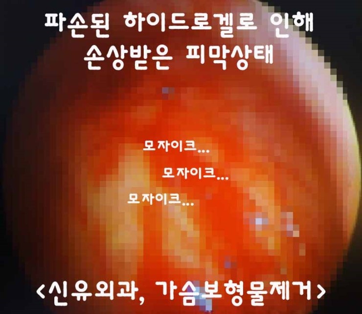 하이드로겔파손을 생리식염수백으로 오인(타병원)하여 제거수술이 늦어졌던 분