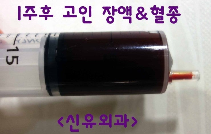 가슴보형물제거와 처진가슴 올리는 거상술(유선재배치법)을 동시에 받으신 전후사진. 