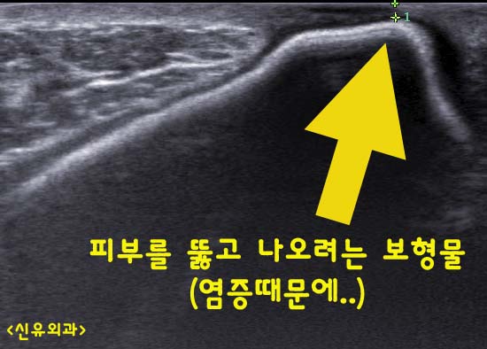 가슴성형 9개월후 염증 구형구축으로 보형물제거, 세척하고 괴사조직과 농양(고름)을 치료했던 분