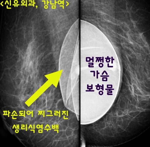 가슴생리식염수백보형물 바닥 연결부위 파손으로 처진가슴이 되어서 오신 분