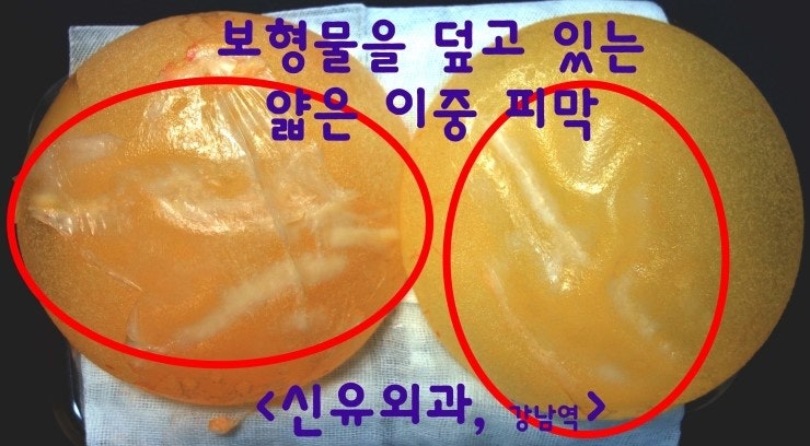 이중피막이 쪼그라들고 다량의 장액이 고여 구형구축처럼 가슴이 딴딴해졌던 분
