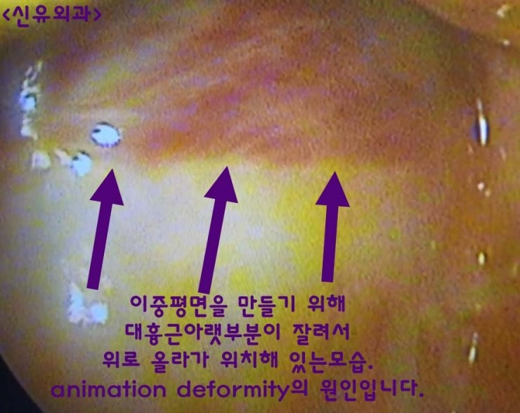 animation deformity의 원인 : 이것이 보여진, 가슴보형물제거수술 받으셨던 분. 