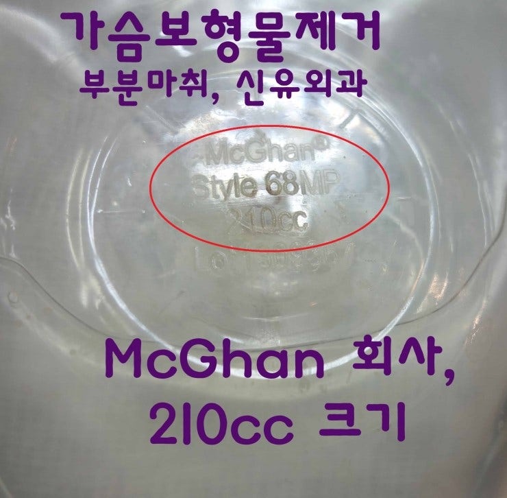 McGhan회사 생리식염수백보형물제거수술하면서 흉터교정술도 같이 해 드린 분.