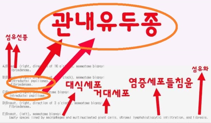 가슴지방이식부작용석회화치료할 때 "관내유두종"도 같이 나왔던 분 수술후기 :유방암을 조심해야.