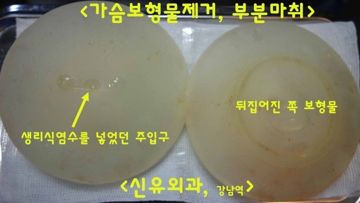 피막을 반드시 제거해야 할까? 조직검사에서 근육조직과 섬유성혈관조직만 나옴. 