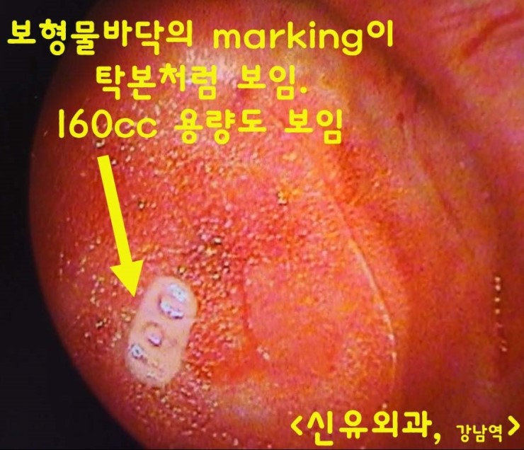 텍스쳐보형물유착이 엄청나서 피막에 marking이 탁본처럼 선명했던 분 가슴보형물제거수술.