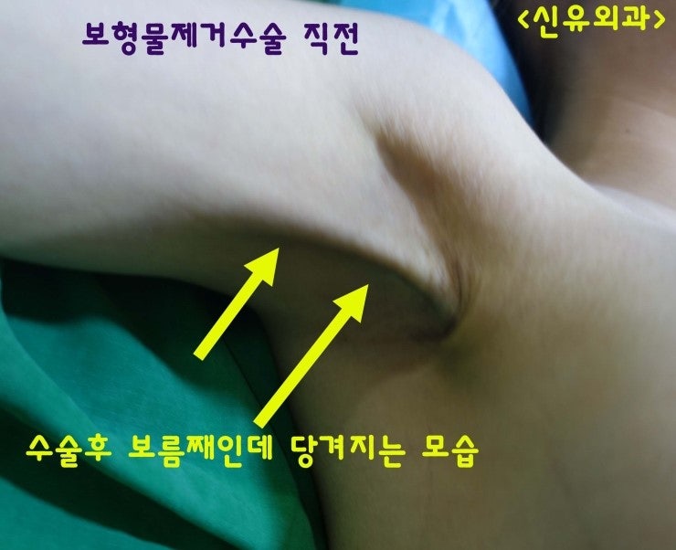 타병원에서 가슴성형수술하시고 15일만에 보형물제거해 드린 분. 