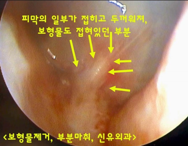 피막 일부가 두꺼워져서 보형물이 밀려있었던 분; 가슴보형물제거수술. 유럽의 CUI 회사 150cc. 