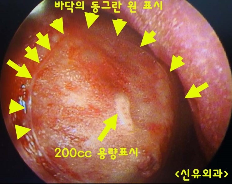 탁본 뜨듯이 가슴보형물 텍스쳐의 유착이 제대로 되어 있던 분 제거수술