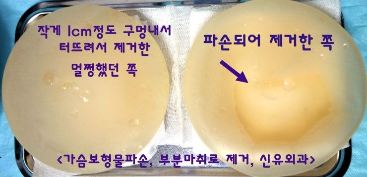 10년이 지나도 생리식염수백 내용물이 깨끗했던 분, 반대쪽 가슴보형물파손으로 제거했던 후기. 