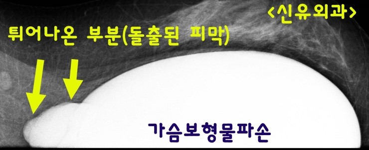 벌집모양 이중피막 너머로, 터진 가슴보형물 코헤시브겔 내용물이 돌출되어 있던 분 제거수술후기. 