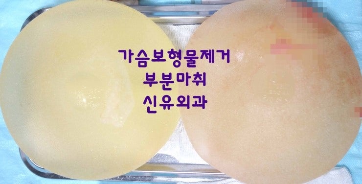 이중피막이 폭포수처럼 있었던 가슴보형물제거수술후기 