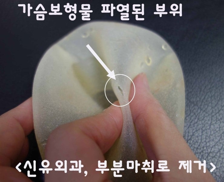 가슴보형물 한가운데 파열이 있으셨던 분 제거수술후기. 