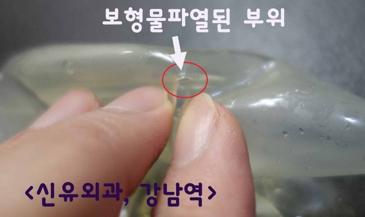 배꼽으로 가슴성형수술 후 10년 만에 보형물파손: 부분마취로 보형물제거하신 분 