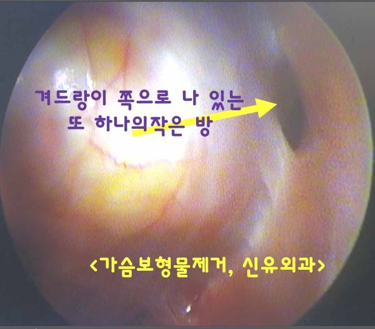겨드랑이쪽에 또다른 방이 존재했던 가슴보형물제거수술후기