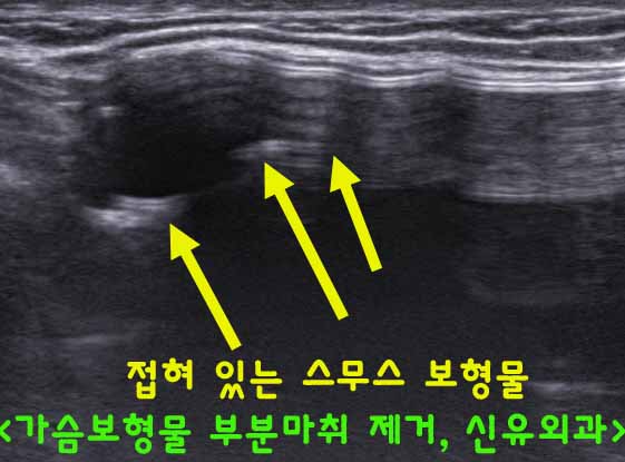 접혀있던 스무스 가슴보형물을 부분마취로 제거한 후, 혈종 생겨서 부풀어 오르셨던 분 수술후기. 