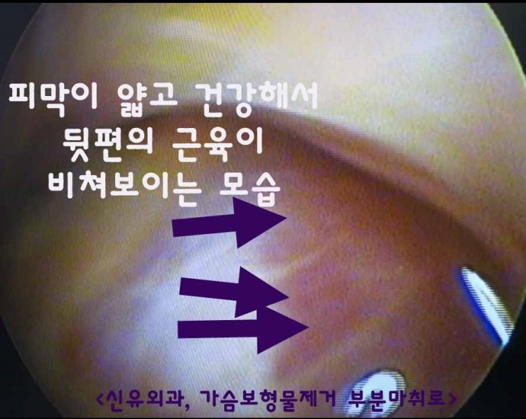 근육의 결까지 보이던 건강한 피막을 가지신 분 가슴보형물제거수술후기(부분마취 1cm절개)