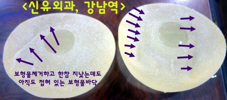 물방울 바닥이 접혀서 이물감 느껴져서 가슴보형물제거하신 분 수술후기