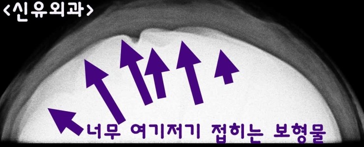 가슴보형물교체 ; 부분마취로 이중피막까지 제거하신 분 수술후기 