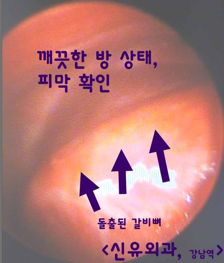 100일만에 다시 겨절로 제거한 가슴보형물수술