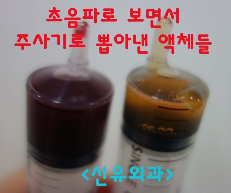 타병원에서 가슴보형물제거후 문제 생겨서, 피막 소독해 드렸던 분. 