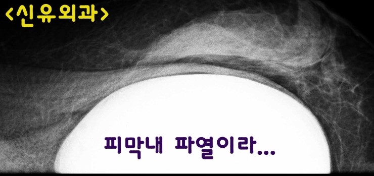가슴보형물 파손으로 제거수술하니, "피막의 조직반응"이라고 나왔던 분