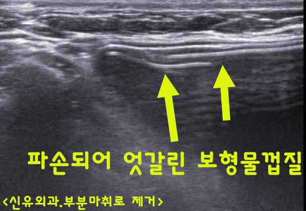 3년만의 가슴보형물파손을 전혀 생각지도 못 하셨던 분, 부분마취로 제거수술하며 처진가슴 올리는 거상술도 같이. 