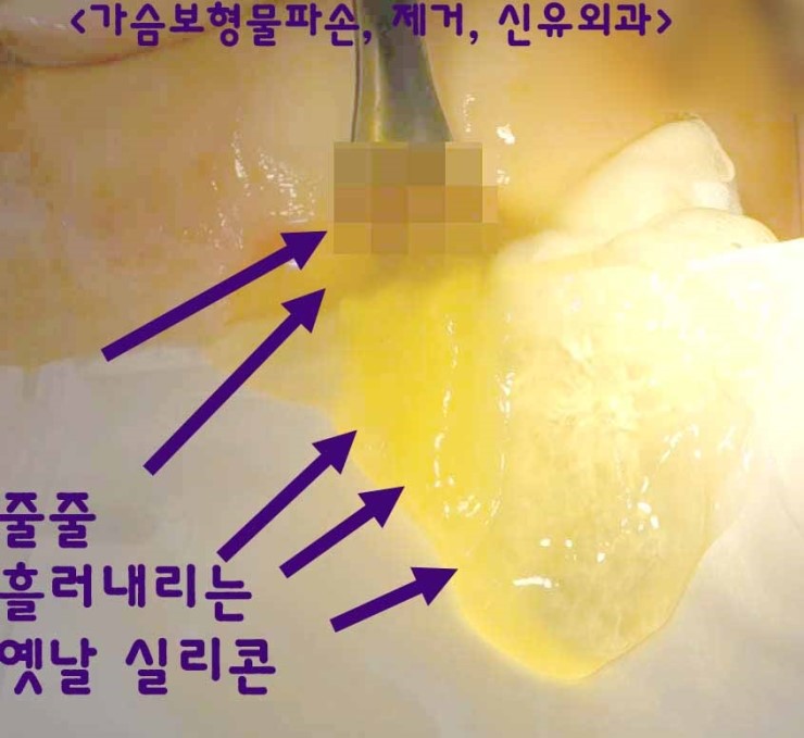 줄줄 흘러내리던 옛날 실리콘 가슴보형물파손제거수술