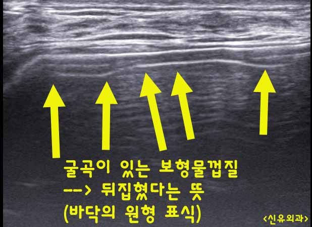 뒤집어진 가슴보형물 제거수술후 피막이 두꺼워져서 과다장액 제거해 드렸던 분