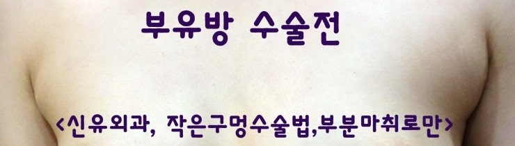 부유방제거수술전후사진-유선제거모습