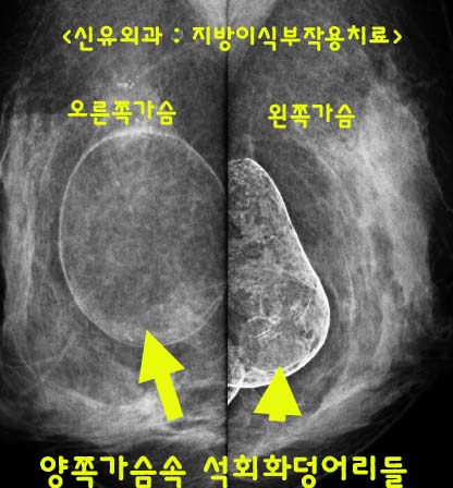 수년간 가슴에 이식된 지방을 품고 사셨던 분, 부작용으로 석회화된 피막까지도 동시에 치료하닷!