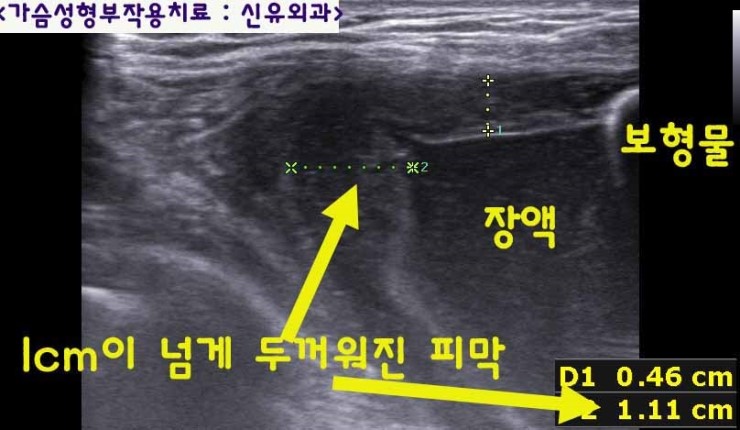 과다장액때문에 구형구축인 줄 알고 오셨고, 가슴보형물교체하며 두꺼워진 피막제거