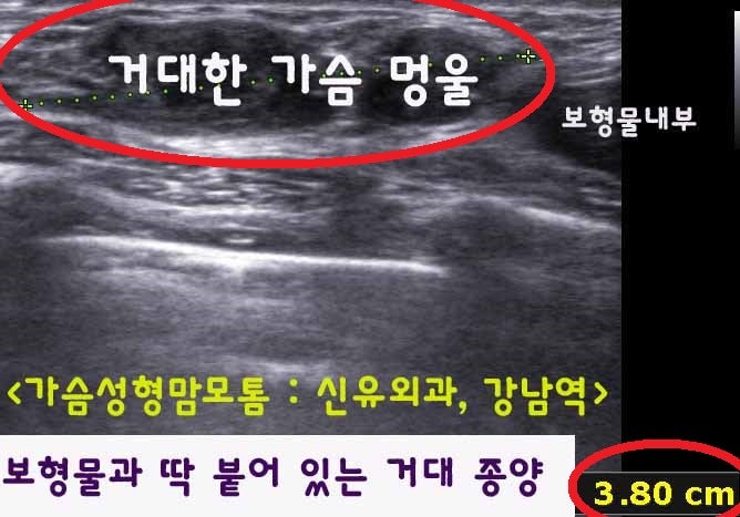 4cm의 거대유방멍울을, 0.4mm 떨어진 보형물의 파손 없이 맘모톰과 특수기구로 제거