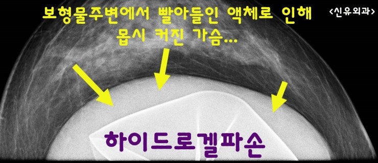 하이드로겔파손을 부분마취로 스무스로 교체하며 처진가슴 올리는 거상술 3cm 성공!