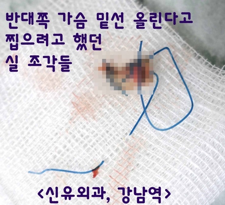 하방변위 교정한다고 밑선 올린다고 겉에서 찝는 수술을 했는데, 보형물파손되며 보형물속에서 실이 나온 경우