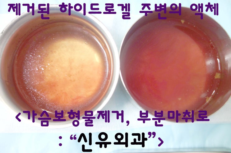 갑작스런 구형구축으로 듣고 오셨으나 하이드로겔파손이었던 경우 : 팽창&수축
