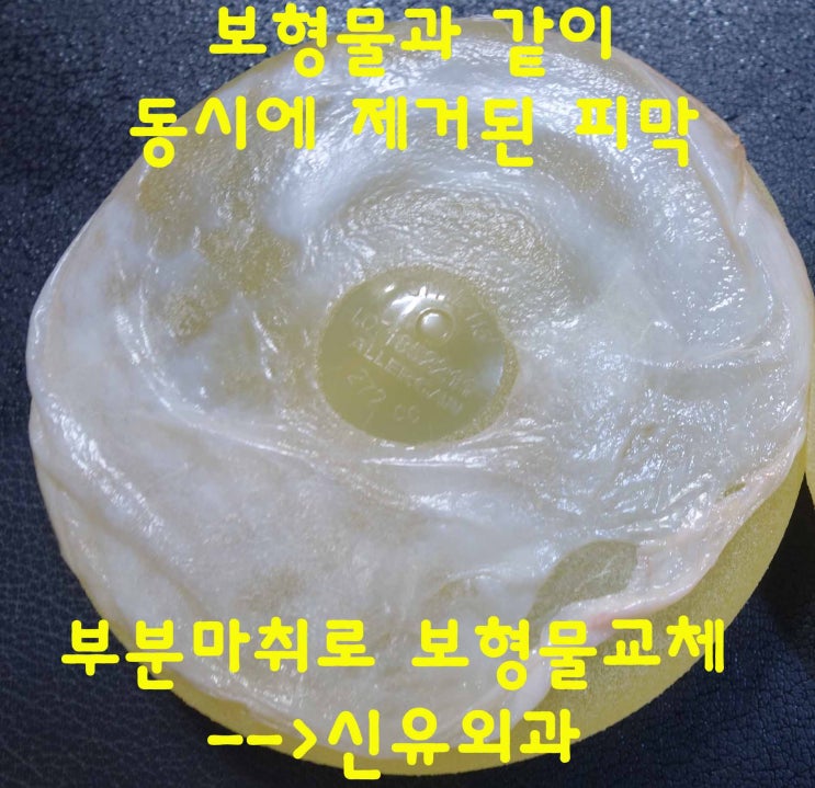 부분마취로 가슴보형물교체하고 방도 교정하고 이중피막도 제거