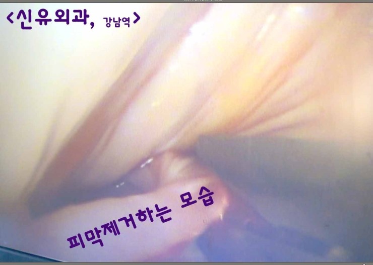 가슴보형물제거를 밑선절개 부분마취로 하고, 이중피막을 내시경으로 보면서 제거했던 분