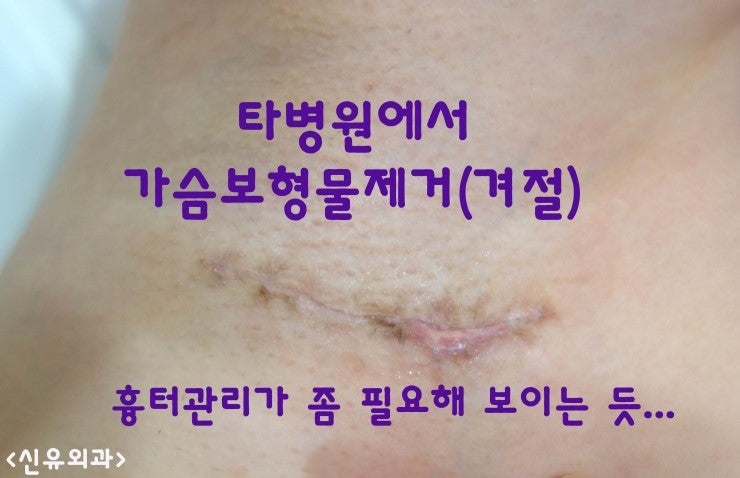 타병원에서 가슴보형물파손제거후 장액종, 혈종때문에 오셔서 초음파로 보면서 주사기로 반복 흡입한 경우