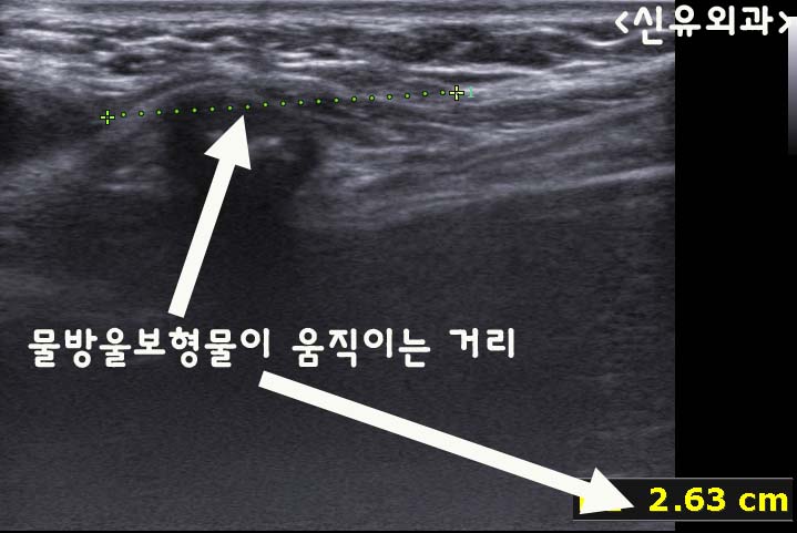 물방울이 아래로 떨어져서 양쪽 가슴의 밑선차이가 생겼던 분. (보형물 비유착 & 하방변위)