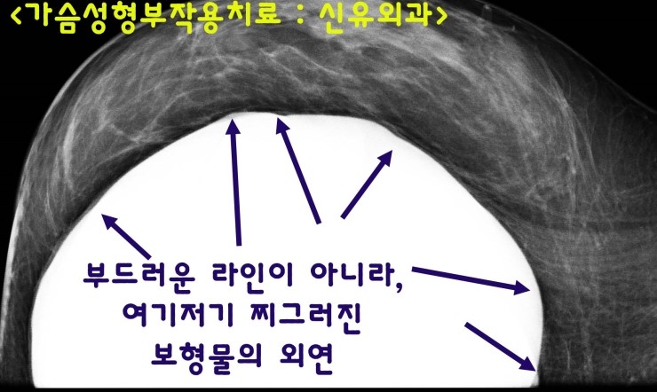 텍스쳐보형물 유착이 떨어져서 피막을 자꾸 긁고, 여기저기 접히기도 했던 가슴성형