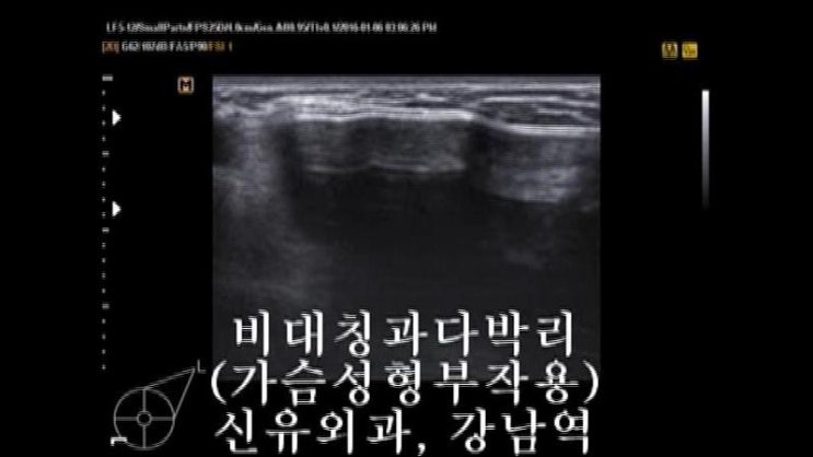 가슴보형물수술후 과다박리 비대칭으로 꿀렁거림이 심하고 팩이 옆구리, 겨드랑이까지 흐른다고 오신 분