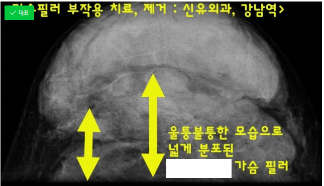 가슴필러부작용 제거 수술의 이런저런 다양한 모습들