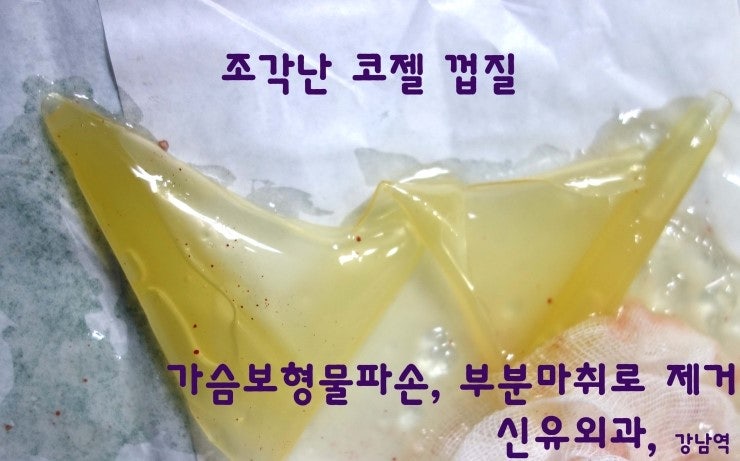 미국병원에서 괜찮다고 했는데 1달후 저희 병원에서 가슴보형물파손 발견된 환자분