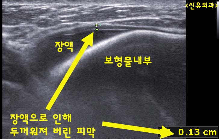가슴성형수술후 고인 장액, 혈종을 초음파유도하에 흡입하는 기술이 없다면 ; 절개창을 또 내야 합니다. 