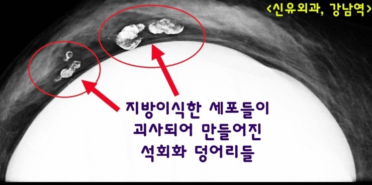 줄기세포가슴지방이식부작용으로 석회화 큰 덩어리가 아파서, 그걸 제거하며 눌린 보형물도 교체 ; 부분마취로.