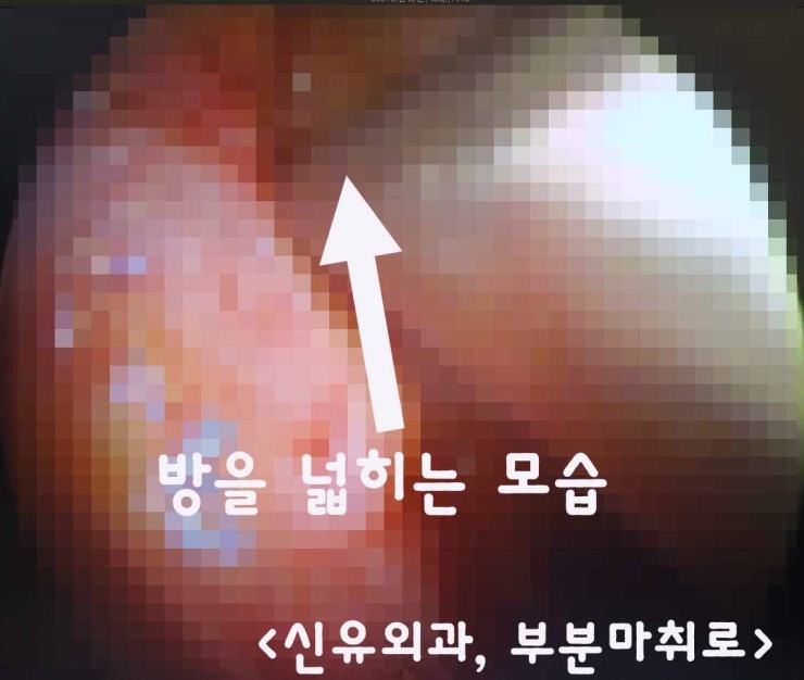 생리식염수백 감촉이 떨어져서, 부분마취로 가슴보형물을 스무스로 교체하고, 방을 더 열어서 교정했던 분