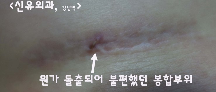 밑선절개의 녹지 않는 봉합사를 제거하고 부분마취로 가슴보형물교체수술